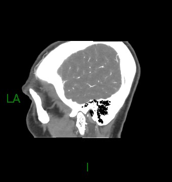 Aneurysmal subarachnoid hemorrhage with intra-axial extension (Radiopaedia 84371-99732 B 9).jpg