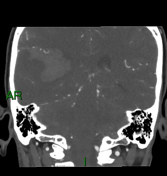 Aneurysmal subarachnoid hemorrhage with intra-axial extension (Radiopaedia 84371-99732 C 40).jpg