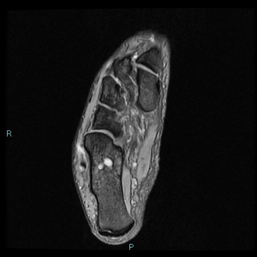 Ankle ganglion cyst (Radiopaedia 62809-71162 Axial Gradient Echo 25).jpg