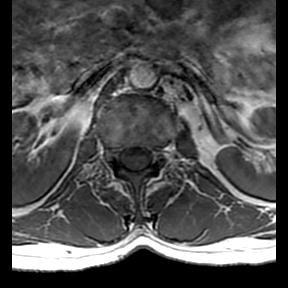 File:Ankylosing spondylitis with zygapophyseal arthritis (Radiopaedia 38433-40516 Axial T1 20).jpg