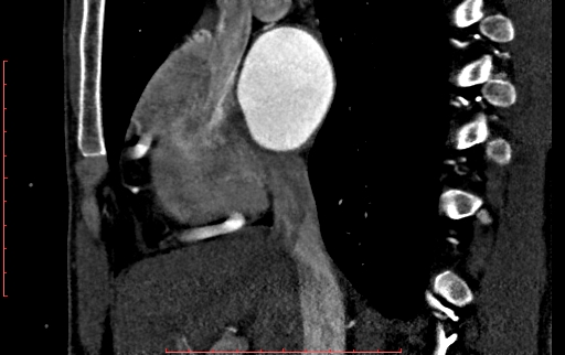 File:Anomalous left coronary artery from the pulmonary artery (ALCAPA) (Radiopaedia 70148-80181 C 58).jpg