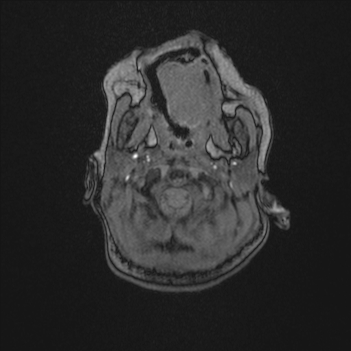 Anoxic brain injury (Radiopaedia 79165-92139 Axial MRA 10).jpg