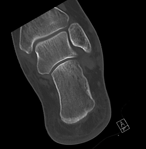 File:Anterior calcaneal process fracture (Radiopaedia 63353-71943 Axial bone window 109).jpg