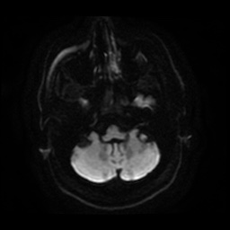 Anterior cerebral artery infarction (Radiopaedia 46794-51323 Axial DWI 7).jpg