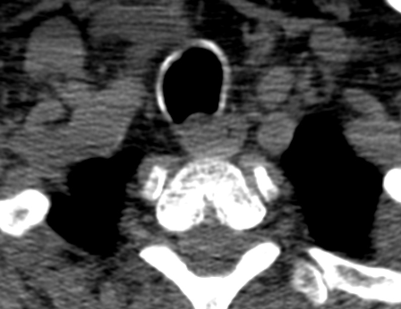 Anterior cervical postdiscectomy arthrodesis (Radiopaedia 32678-33646 Axial non-contrast 69).jpg