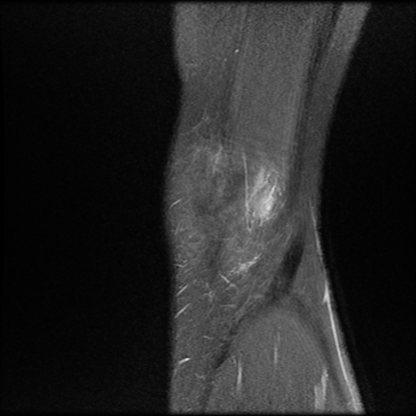 File:Anterior cruciate ligament graft tear and bucket-handle tear of medial meniscus (Radiopaedia 75867-87254 Sagittal PD fat sat 2).jpg