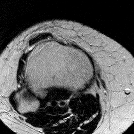File:Anterior cruciate ligament mucoid degeneration (Radiopaedia 60853-68633 Axial T2 7).jpg