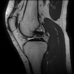 Anterior cruciate ligament rupture and posteromedial corner injury (Radiopaedia 67338-76723 Sagittal PD 73).jpg