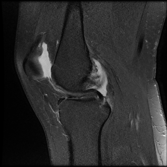 File:Anterior cruciate ligament tear, Wrisberg rip and bucket-handle tear of medial meniscus (Radiopaedia 75872-87266 Sagittal PD fat sat 16).jpg
