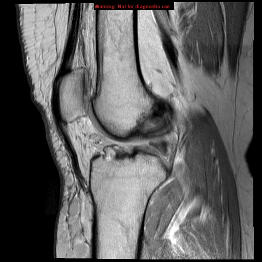 File:Anterior cruciate ligament tear (Radiopaedia 12329-12612 Sagittal T2 fat sat 10).jpg