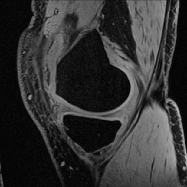 Anterior cruciate ligament tear - ramp lesion (Radiopaedia 71883-82322 Sagittal T1 vibe 103).jpg