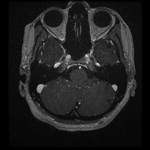 Anterior inferior cerebellar artery vascular loop - type II (Radiopaedia 70991-81209 Axial T1 C+ 60).jpg
