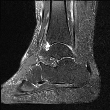 File:Anterior talofibular ligament injury - rupture with soft-tissue impingement (Radiopaedia 38765-40928 Sagittal PD fat sat 11).jpg
