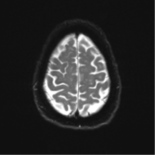 Anterior temporal pole cysts (Radiopaedia 46629-51102 Axial DWI 23).png