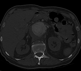 File:Anterior vertebral scalloping (abdominal aortic aneurysm) (Radiopaedia 66744-76067 Axial bone window 33).jpg