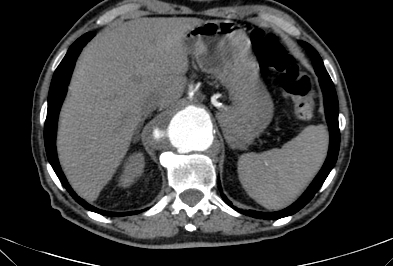 File:Anterior vertebral scalloping (abdominal aortic aneurysm) (Radiopaedia 66744-76067 F 5).jpg