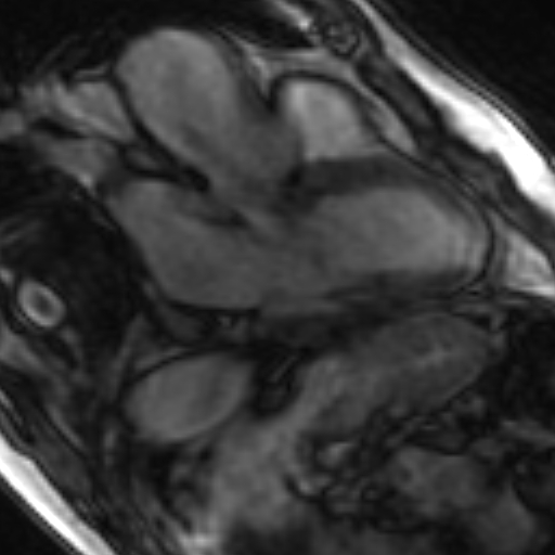 File:Anteroseptal hypokinesia after myocardial infarction (Radiopaedia 15978-15633 3 chamber view SSFE 11).jpg