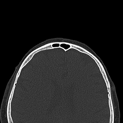 Antral exostoses (Radiopaedia 22371-22396 Axial bone window 52).jpg