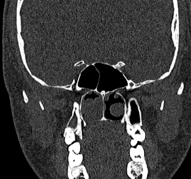 Antrochoanal polyp (Radiopaedia 30002-30554 Coronal bone window 56).jpg