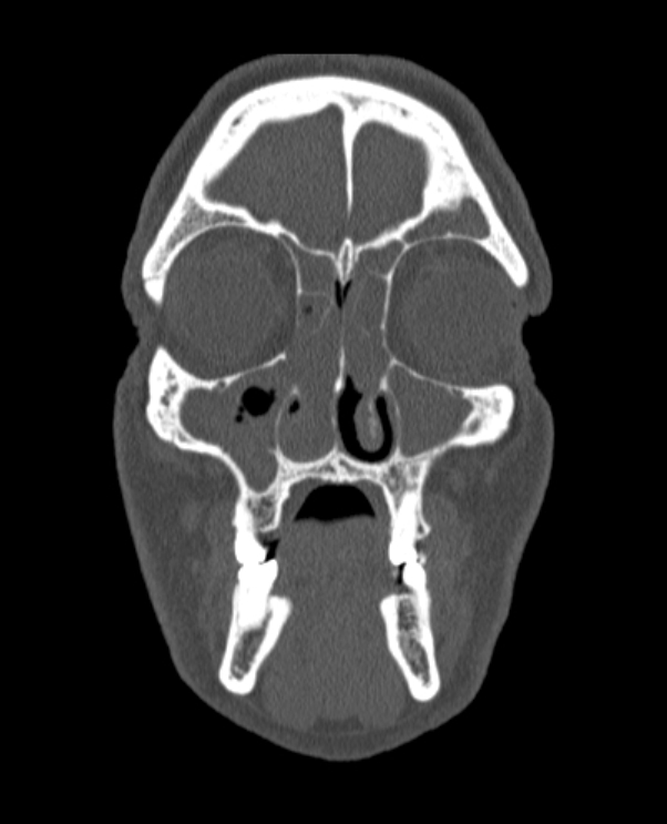 Antrochoanal polyp (Radiopaedia 79011-92169 Coronal bone window 63).jpg