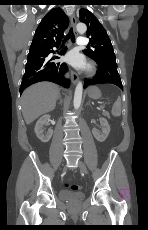 Aortectomy and axillary-bifemoral bypass (Radiopaedia 28303-28545 C 54).jpg