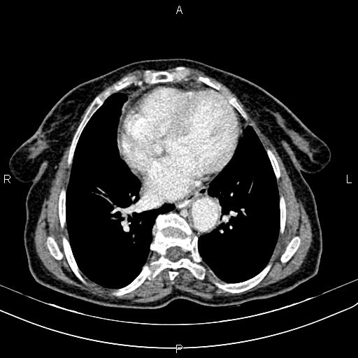 File:Aortic aneurysm and Lemmel syndrome (Radiopaedia 86499-102554 A 3).jpg