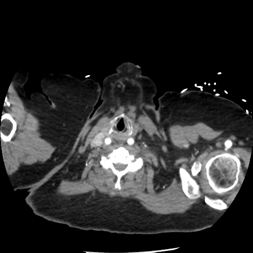 File:Aortic aneurysm and dissection - Stanford type A (Radiopaedia 36693-38261 A 3).png