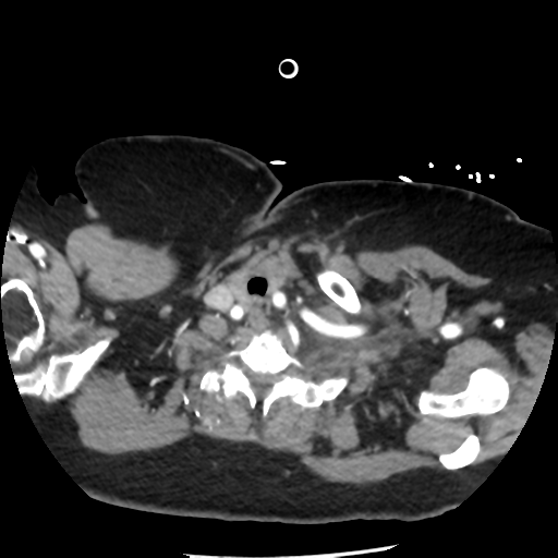 File:Aortic aneurysm and dissection - Stanford type A (Radiopaedia 36693-38261 A 7).png
