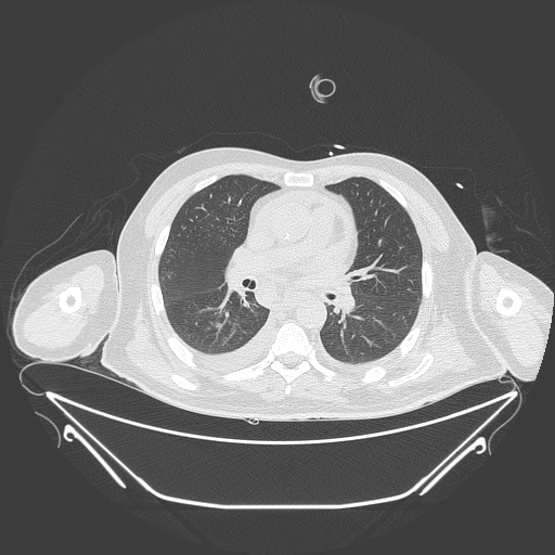 Aortic arch aneurysm (Radiopaedia 84109-99365 Axial lung window 141).jpg