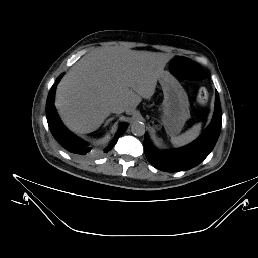Aortic arch aneurysm (Radiopaedia 84109-99365 Axial non-contrast 261).jpg