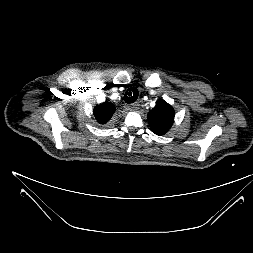 Aortic arch aneurysm (Radiopaedia 84109-99365 B 85).jpg