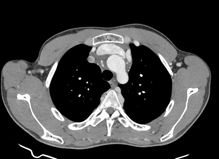 File:Aortic coarctation with aneurysm (Radiopaedia 74818-85828 A 153).jpg