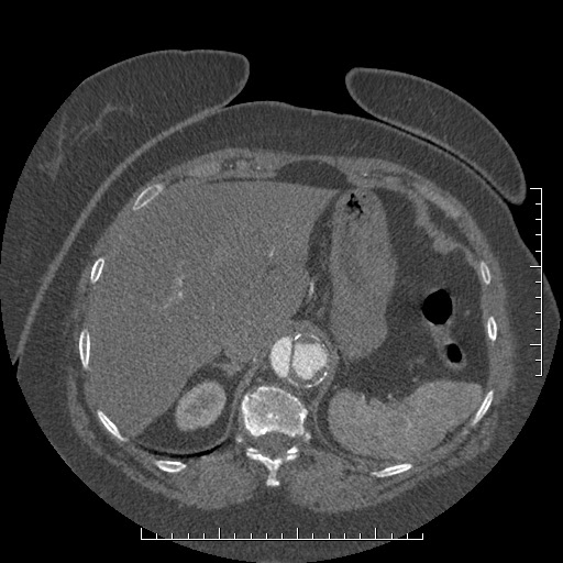 File:Aortic dissection- Stanford A (Radiopaedia 35729-37268 B 30).jpg