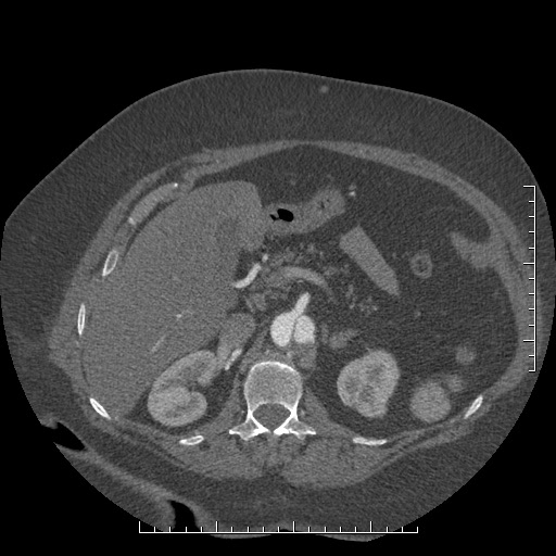 Aortic dissection- Stanford A (Radiopaedia 35729-37268 B 52).jpg