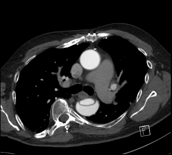 File:Aortic dissection (CTPA) (Radiopaedia 75506-86750 A 40).jpg