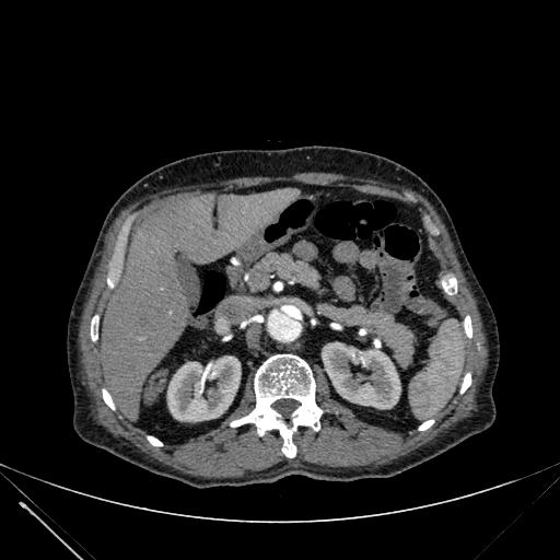Aortic dissection (Radiopaedia 27466-27665 C+ arterial phase 320).jpg