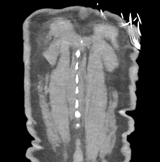 File:Aortic dissection - Stanford type B (Radiopaedia 50171-55512 B 82).png