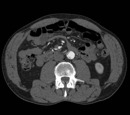 Aortic dissection - Stanford type B (Radiopaedia 73648-84437 A 168).jpg