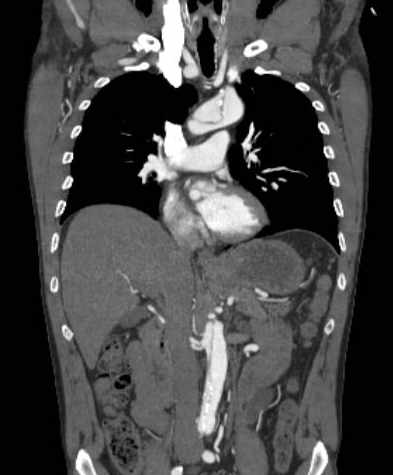 File:Aortic dissection - Stanford type B (Radiopaedia 73648-84437 B 56).jpg