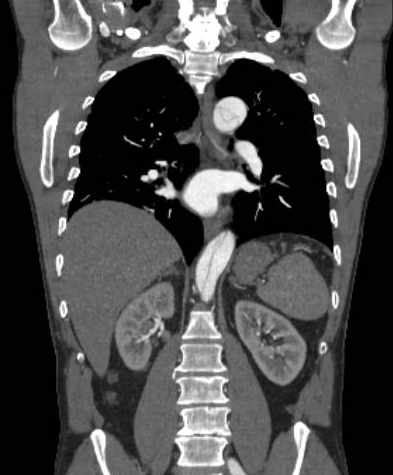 File:Aortic dissection - Stanford type B (Radiopaedia 73648-84437 B 74).jpg