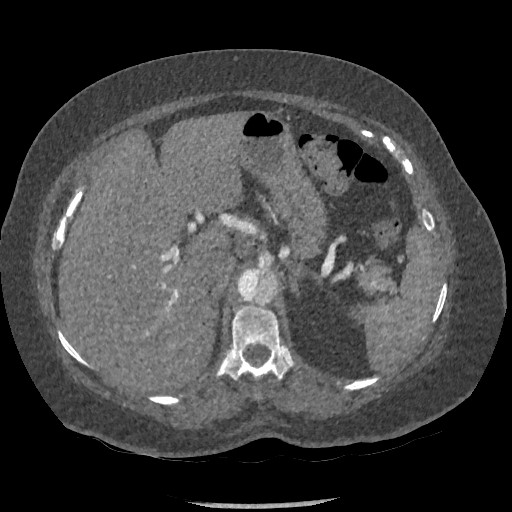 Aortic dissection - Stanford type B (Radiopaedia 88281-104910 A 100).jpg