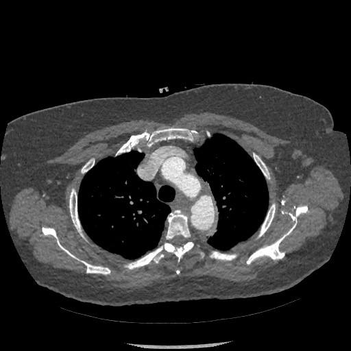 Aortic dissection - Stanford type B (Radiopaedia 88281-104910 A 15).jpg