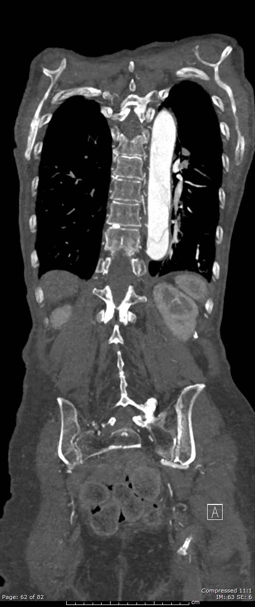 Aortic dissection with extension into aortic arch branches (Radiopaedia 64402-73204 A 62).jpg