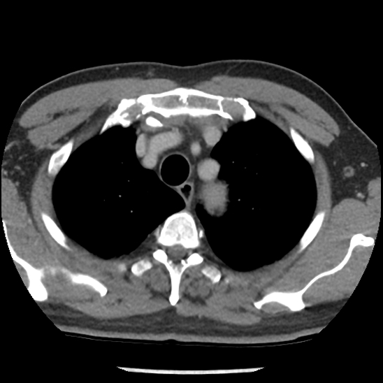 Aortic intramural hematoma (type B) (Radiopaedia 79323-92387 Axial C+ delayed 8).jpg