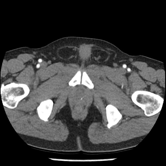 Aortic intramural hematoma (type B) (Radiopaedia 79323-92387 B 119).jpg