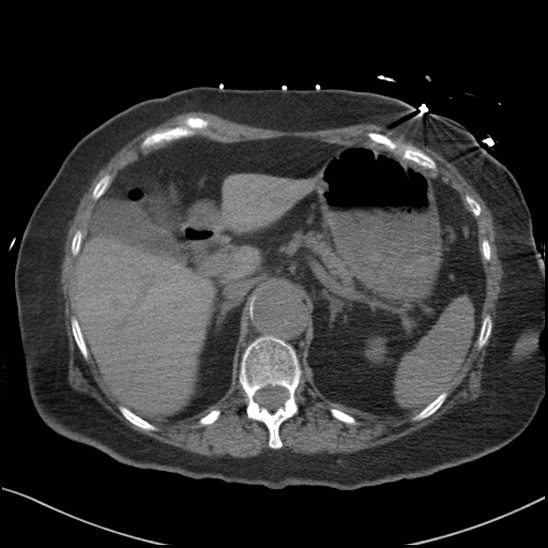 Aortic intramural hematoma with dissection and intramural blood pool (Radiopaedia 77373-89491 Axial non-contrast 98).jpg