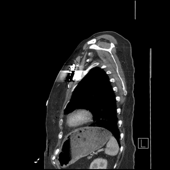 Aortic intramural hematoma with dissection and intramural blood pool (Radiopaedia 77373-89491 D 73).jpg
