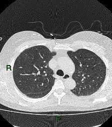 File:Aortic valve endocarditis (Radiopaedia 87209-103485 Axial lung window 34).jpg