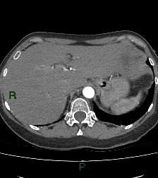 Aortic valve endocarditis (Radiopaedia 87209-103485 C 90).jpg