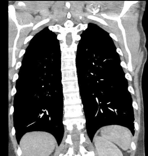 File:Aortic valve non-coronary cusp thrombus (Radiopaedia 55661-62189 C 61).png
